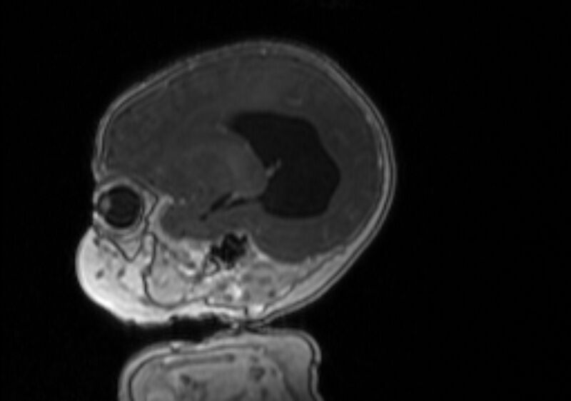 File:Chiari III malformation with occipital encephalocele (Radiopaedia 79446-92559 Sagittal T1 C+ mpr 47).jpg
