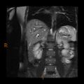 Cholelithiasis with biliary dilatation (Radiopaedia 49442-54589 Coronal T2 1).jpg