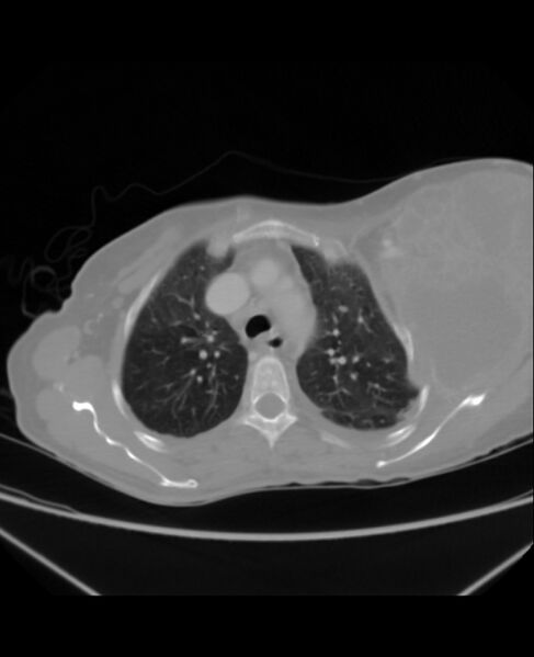 File:Chondrosarcoma (Radiopaedia 79427-92535 Axial lung window 14).jpg
