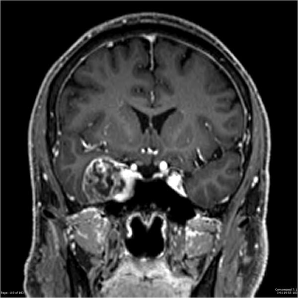 File:Chondrosarcoma of skull base- grade II (Radiopaedia 40948-43654 Coronal T1 C+ 30).jpg