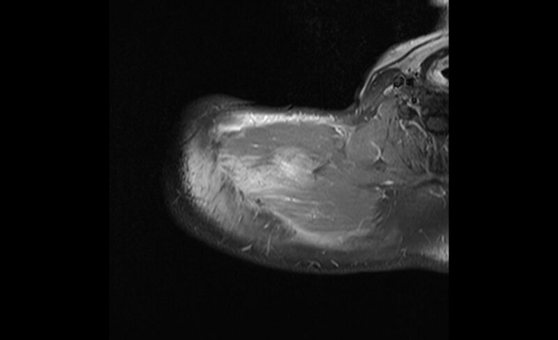 File:Choriocarcinoma in the shoulder (Radiopaedia 28603-28861 Axial T1 C+ fat sat 3).jpg