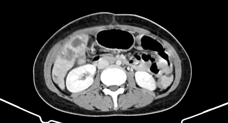File:Choriocarcinoma liver metastases (Radiopaedia 74768-85766 A 106).jpg