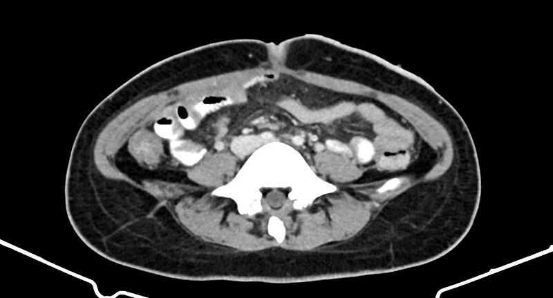 File:Choriocarcinoma liver metastases (Radiopaedia 74768-85766 A 132).jpg
