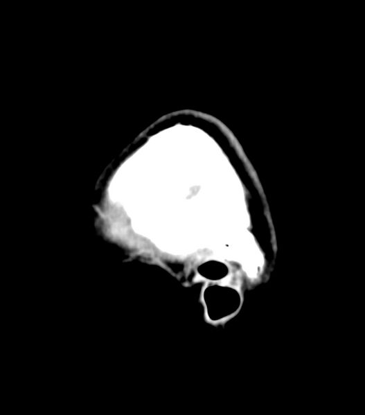 File:Choroid plexus carcinoma (Radiopaedia 91013-108552 B 7).jpg