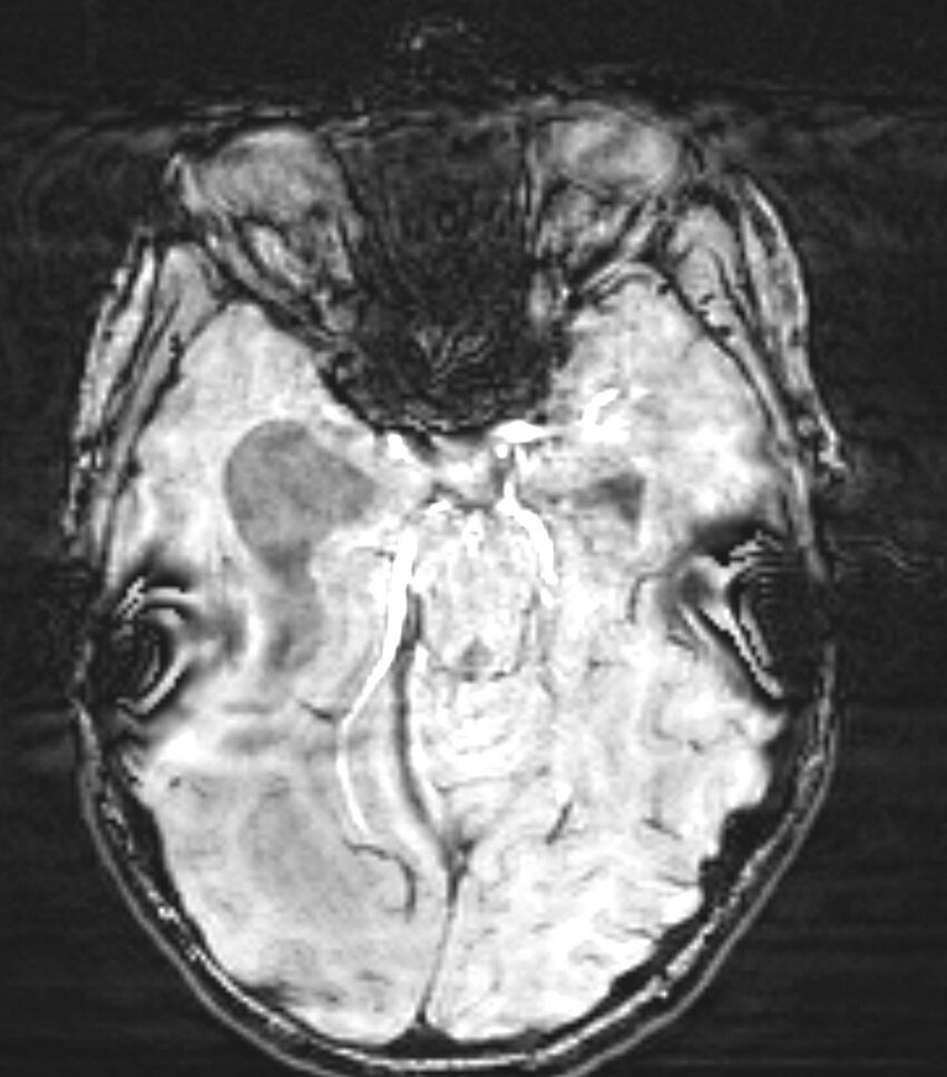 Choroid plexus carcinoma (Radiopaedia 91013-108553 Axial SWI 35).jpg