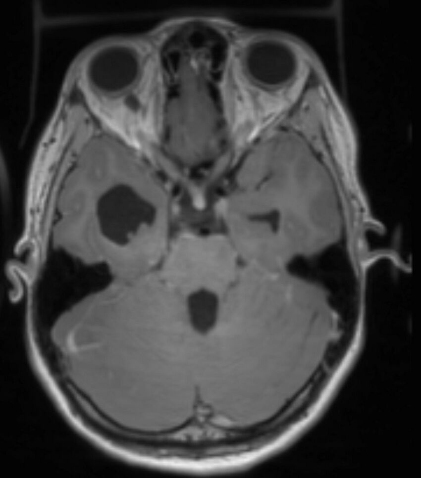 Choroid plexus carcinoma (Radiopaedia 91013-108553 Axial T1 C+ 107).jpg