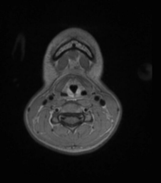 File:Choroid plexus carcinoma (Radiopaedia 91013-108553 Axial T1 C+ 13).jpg