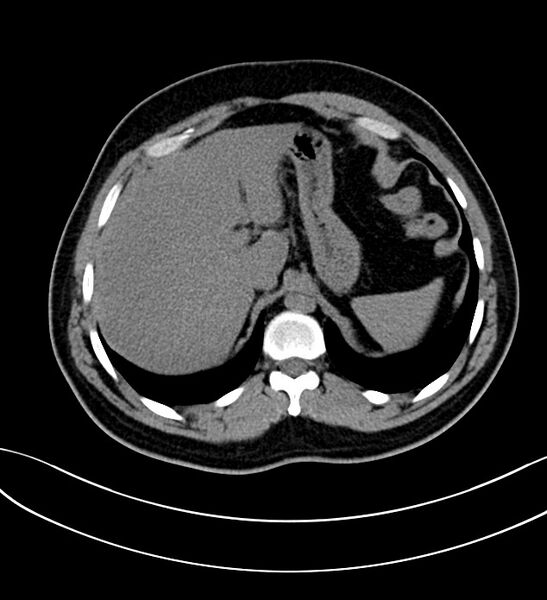 File:Chromophobe renal cell carcinoma (Radiopaedia 84286-99573 Axial non-contrast 5).jpg