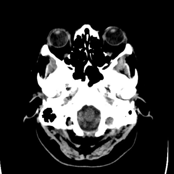 File:Chronic bilateral occipital lobe infarcts (Radiopaedia 31276-31996 Axial non-contrast 5).jpg