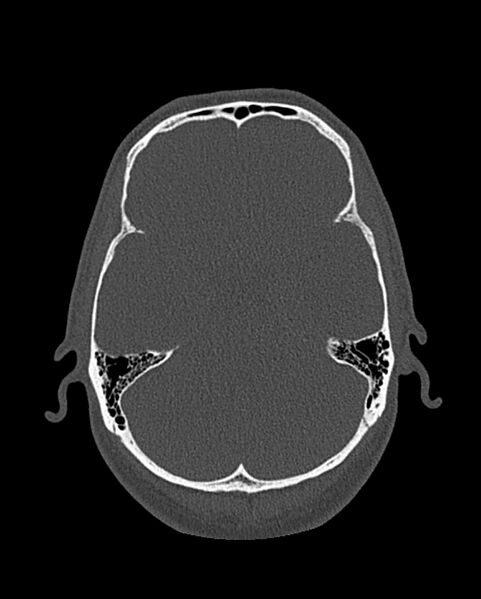 File:Chronic maxillary sinusitis caused by a foreign body (Radiopaedia 58521-65676 Axial bone window 292).jpg