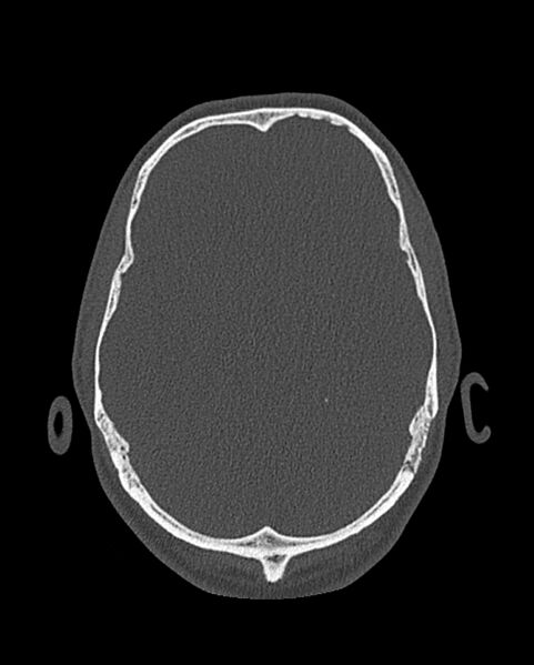 File:Chronic maxillary sinusitis caused by a foreign body (Radiopaedia 58521-65676 Axial bone window 325).jpg