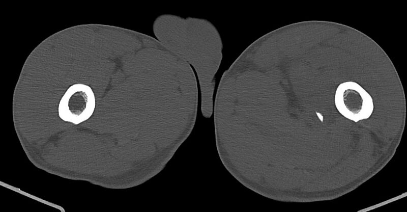 File:Chronic osteomyelitis (with sequestrum) (Radiopaedia 74813-85822 Axial non-contrast 72).jpg