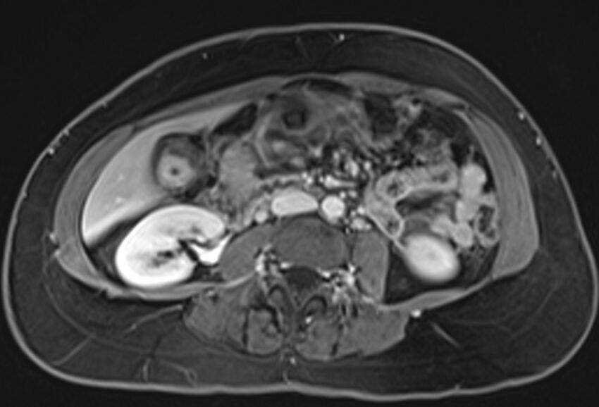 Chronic pancreatitis - pancreatic duct calculi (Radiopaedia 71818-82250 Axial T1 C+ fat sat 45).jpg