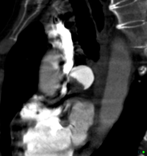 File:Chronic pulmonary embolism (Radiopaedia 17943-17702 Sagittal C+ CTPA 1).jpg