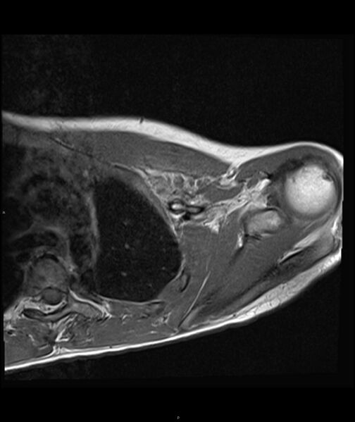 File:Chronic reactive multifocal osteomyelitis (CRMO) - clavicle (Radiopaedia 56406-63071 Axial T1 14).jpg