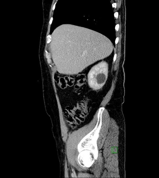 File:Clear cell renal cell carcinoma (Radiopaedia 85006-100539 G 49).jpg