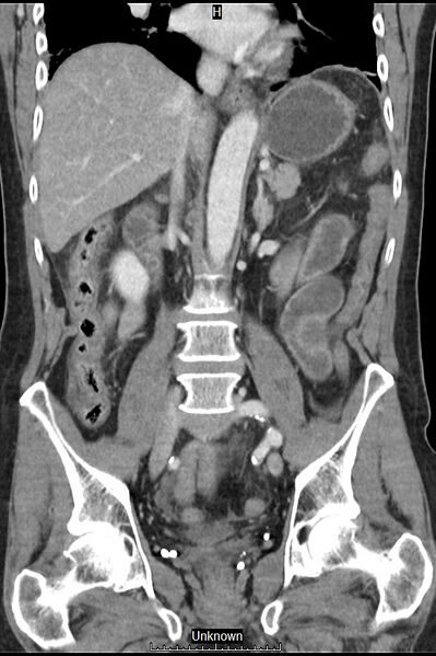 File:Closed loop bowel obstruction and ischemia (Radiopaedia 86959-103180 B 24).jpg