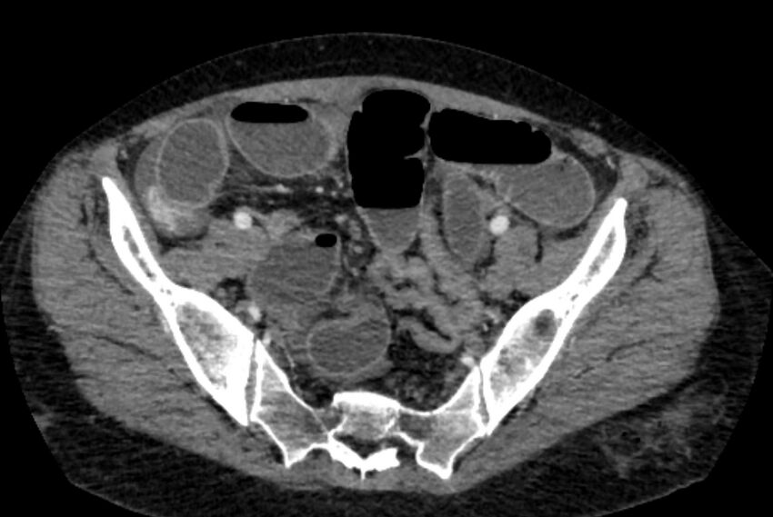 Closed loop small bowel obstruction (Radiopaedia 71211-81508 A 125).jpg