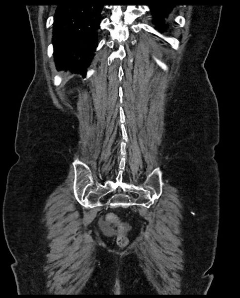 File:Closed loop small bowel obstruction - adhesions (Radiopaedia 59269-66611 B 107).jpg
