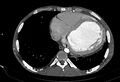 Coarctation of aorta with aortic valve stenosis (Radiopaedia 70463-80574 A 160).jpg