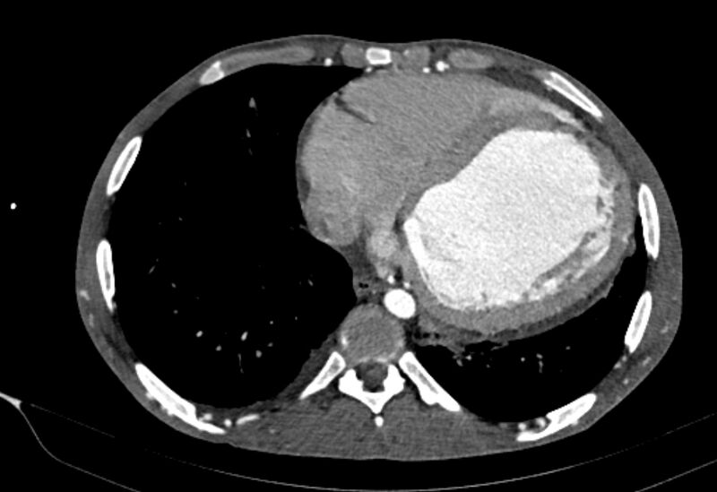 File:Coarctation of aorta with aortic valve stenosis (Radiopaedia 70463-80574 A 160).jpg
