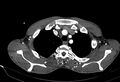 Coarctation of aorta with aortic valve stenosis (Radiopaedia 70463-80574 A 8).jpg