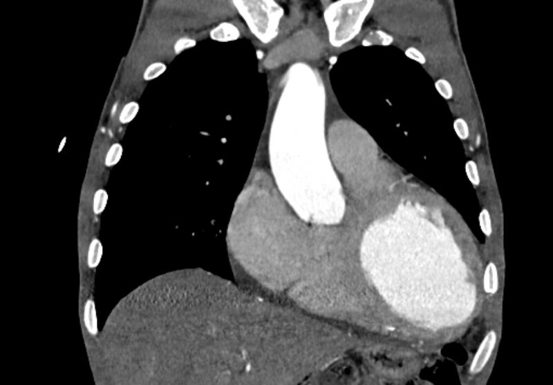 File:Coarctation of aorta with aortic valve stenosis (Radiopaedia 70463-80574 C 66).jpg
