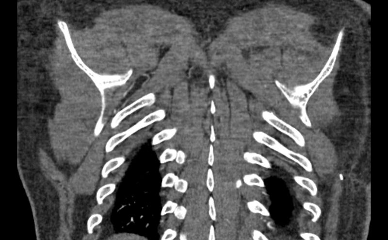 File:Coarctation of the aorta (Radiopaedia 53363-59343 C 64).jpg