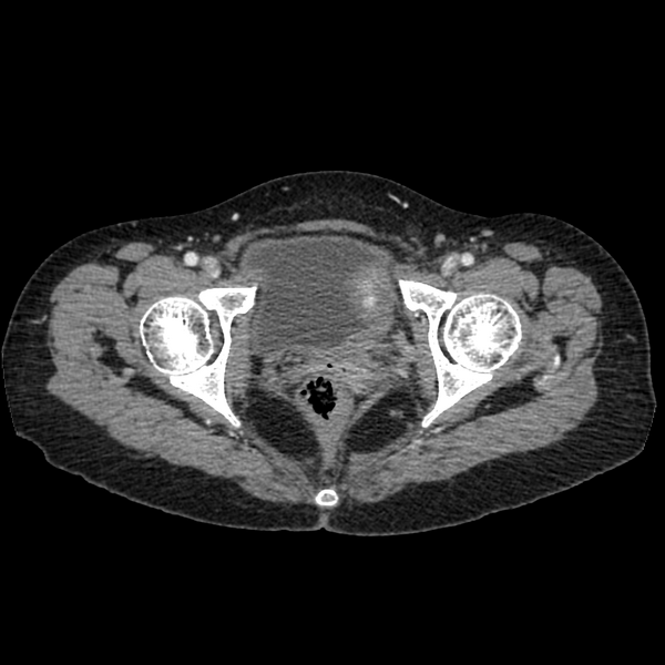 File:Cocoon abdomen with possible tubo-ovarian abscess (Radiopaedia 46235-50636 A 42).png