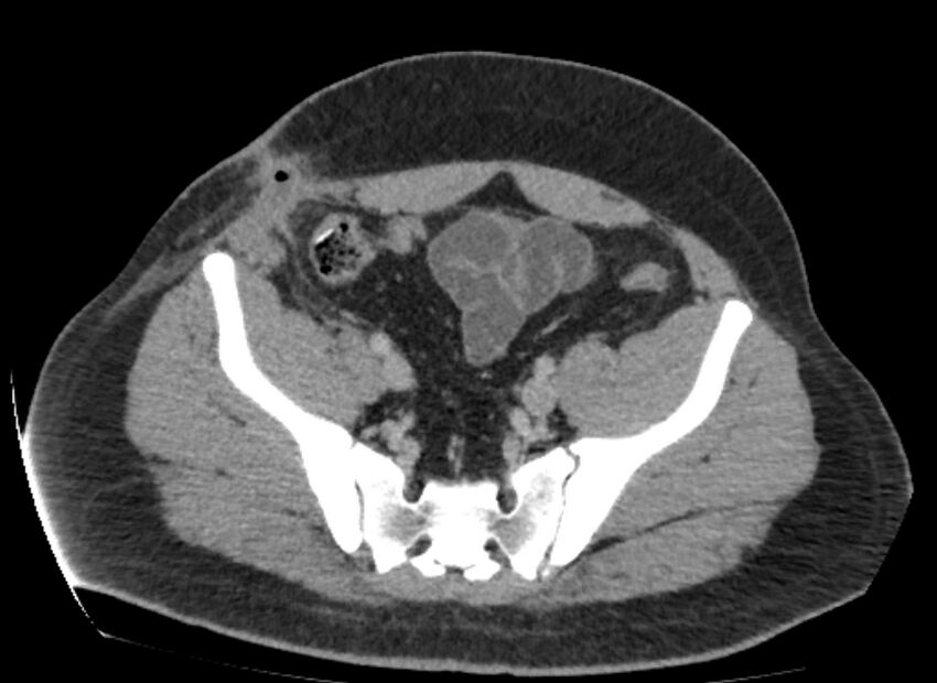 Colocutaneous fistula (Radiopaedia 56401-63062 A 75).jpg