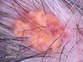 Dermoscopy view (DermNet NZ sebaceous-carcinoma-02).jpg