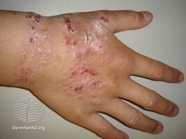 Hand eczema