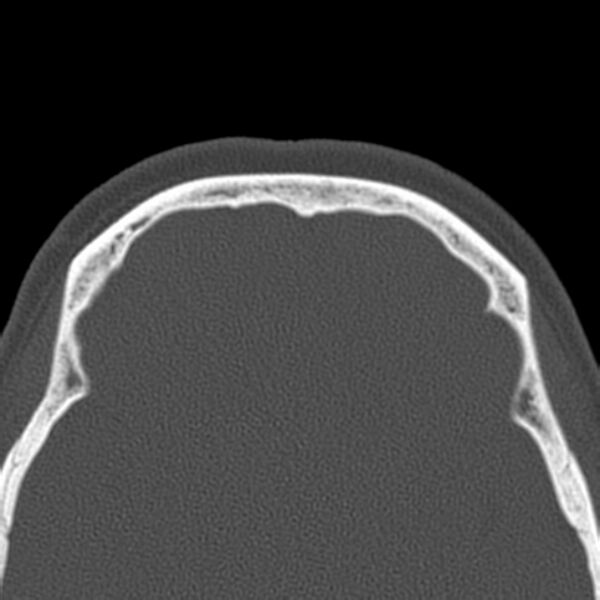 File:Nasolabial cyst (Radiopaedia 33987-35205 Axial bone window 45).jpg