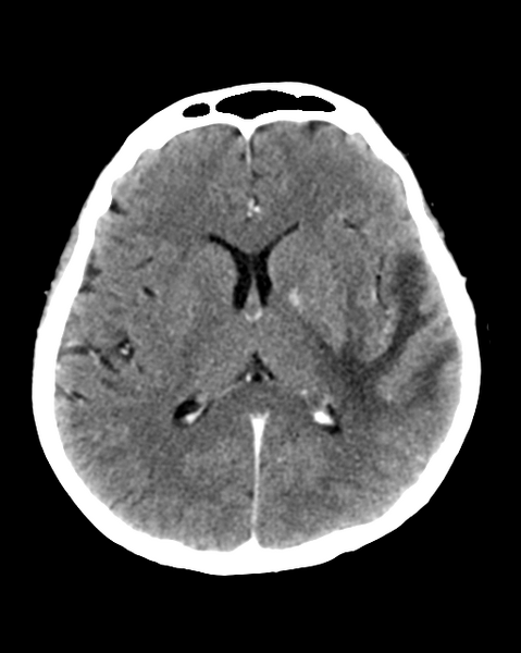 File:Nasopharyngeal carcinoma with cerebral abscess (Radiopaedia 43018-46275 Axial C+ delayed 28).png