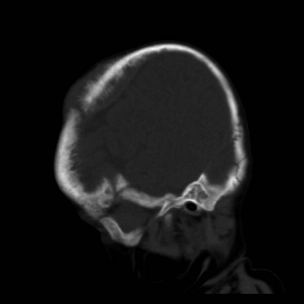 File:Neuroblastoma with skull metastases (Radiopaedia 30326-30958 Sagittal bone window 7).jpg