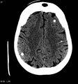 Neurocysticercosis (Radiopaedia 7773-8596 non-contrast 11).jpg