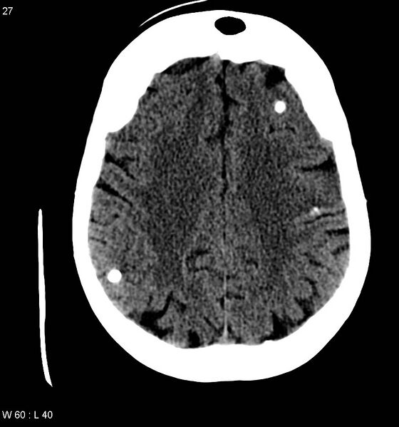 File:Neurocysticercosis (Radiopaedia 7773-8596 non-contrast 11).jpg