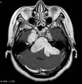 Neurofibromatosis type 2 - cranial and spinal involvement (Radiopaedia 5351-7111 Axial T1 C+ 5).jpg