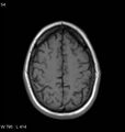 Neurosarcoidosis (Radiopaedia 10930-11351 Axial T1 16).jpg