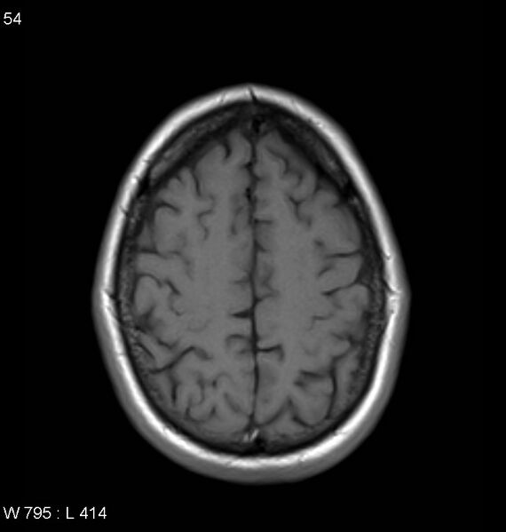 File:Neurosarcoidosis (Radiopaedia 10930-11351 Axial T1 16).jpg