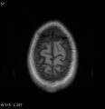 Neurosarcoidosis (Radiopaedia 10930-17204 Axial T1 19).jpg