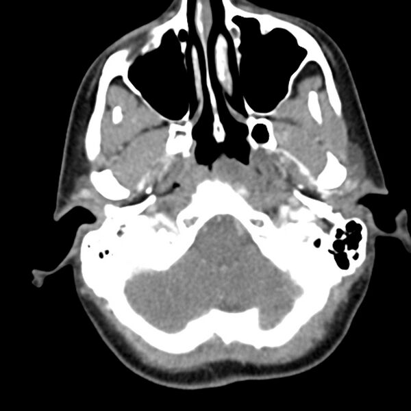 File:Normal CT of the neck (Radiopaedia 14575-14500 Axial C+ 15).jpg