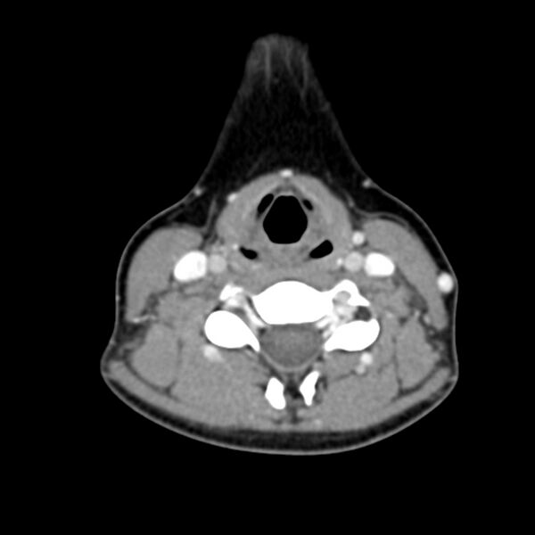 File:Normal CT of the neck (Radiopaedia 14575-14500 Axial C+ 43).jpg