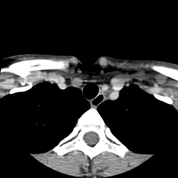 File:Normal CT of the neck (Radiopaedia 14575-14500 Axial C+ 66).jpg