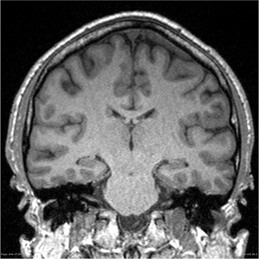 Normal brain MRI (non-focal epilepsy protocol) (Radiopaedia 38571-40700 Coronal T1 49).jpg