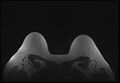 Normal breast MRI - dense breasts (Radiopaedia 80454-93850 Axial T1 194).jpg