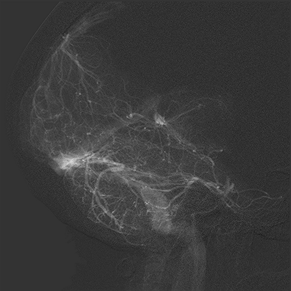 File:Normal cerebral angiogram (four vessel DSA) (Radiopaedia 41708-44649 L 17).png