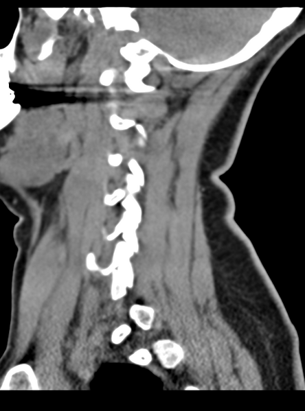 File:Normal cervical spine MRI (including Dixon) (Radiopaedia 42762-45926 C 15).png