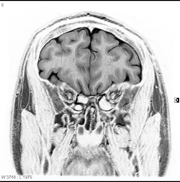 File:Normal coronal brain (Radiopaedia 6676-7910 B 8).jpg