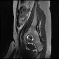 Normal female pelvis MRI (retroverted uterus) (Radiopaedia 61832-69933 Sagittal T2 3).jpg
